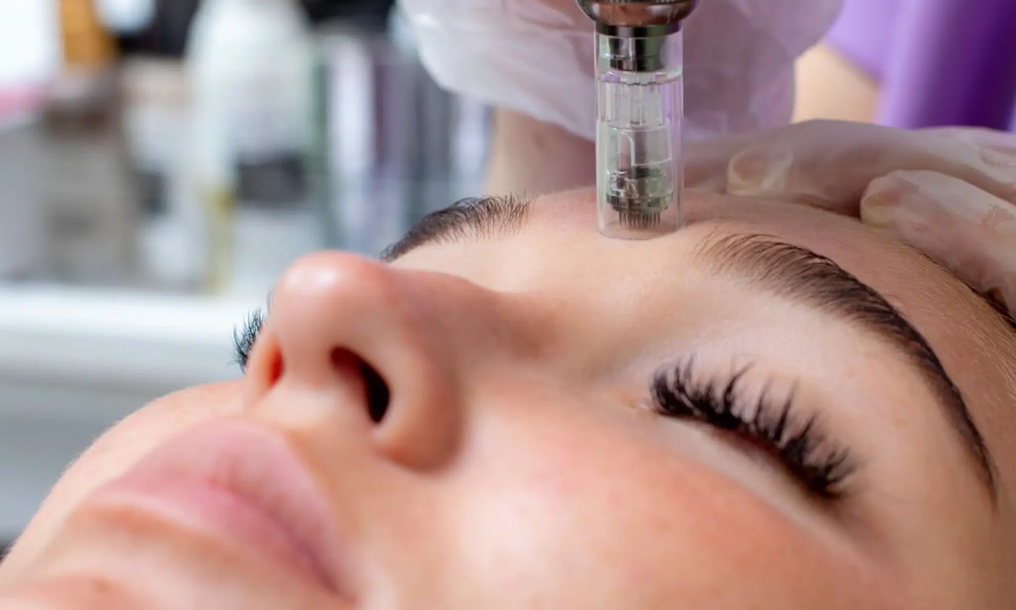 Microneedling | River Oaks Skin Institute Houston Tx